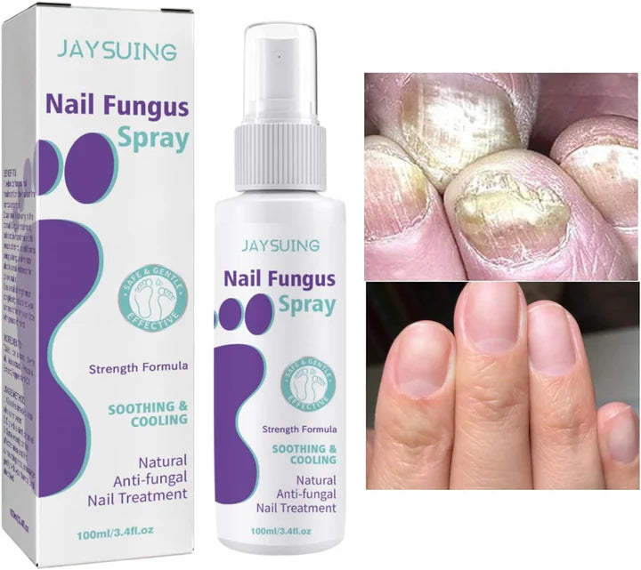 Fungal Nail Treatment