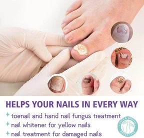 Fungal Nail Treatment